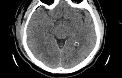 Stradiņa slimnīcā veikta unikāla neiroķirurģiska operācija – caur galvaskausu izoperēts audzējs acs dobumā aiz acs ābola