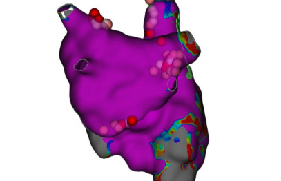 Jauns solis sirds ārstēšanā: katetra ablācija palīdz novērst sirdsdarbības pauzes un samaņas zudumus