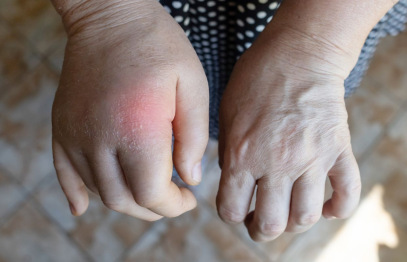 Stradiņa slimnīcā diskutēs par retu slimību – hereditāro angioedēmu kas ietekmē ne tikai veselību, bet visu dzīvi