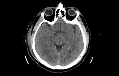 Stradiņa slimnīcā veikta unikāla neiroķirurģiska operācija – caur galvaskausu izoperēts audzējs acs dobumā aiz acs ābola